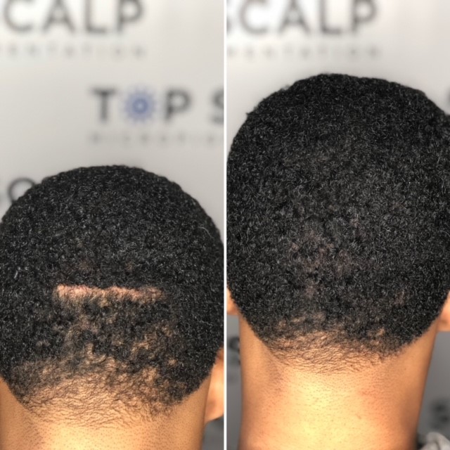 Scalp micropigmentation for scarring