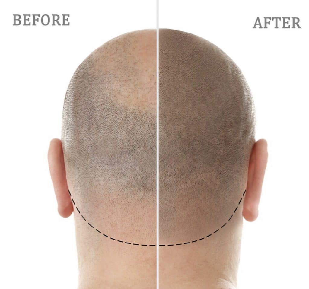before and after scalp micropigmentation comparison