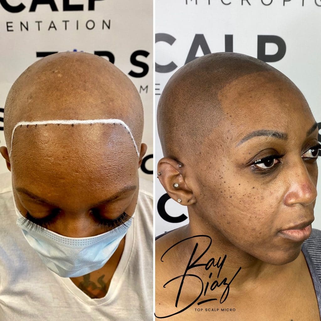 Scalp micropigmentation hairline restoration